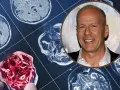 Bruce Willis choroba: obraz rezonansu magnetycznego mózgu obok uśmiechniętej twarzy aktora.