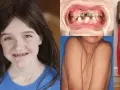Dziecko z widocznymi problemami z zębami i ramionami, przypominające Gaten Matarazzo choroba.