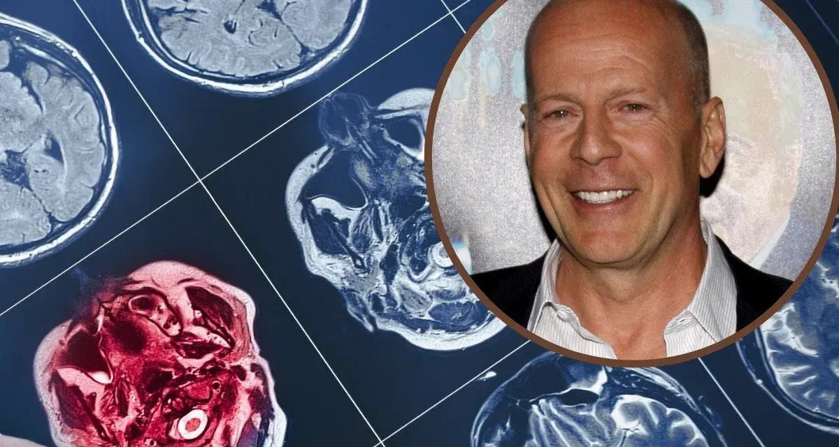 Bruce Willis choroba: obraz rezonansu magnetycznego mózgu obok uśmiechniętej twarzy aktora.