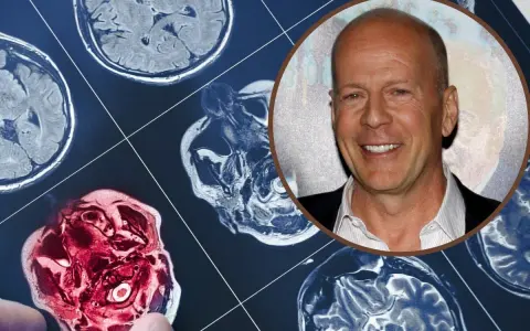 Bruce Willis choroba: obraz rezonansu magnetycznego mózgu obok uśmiechniętej twarzy aktora.