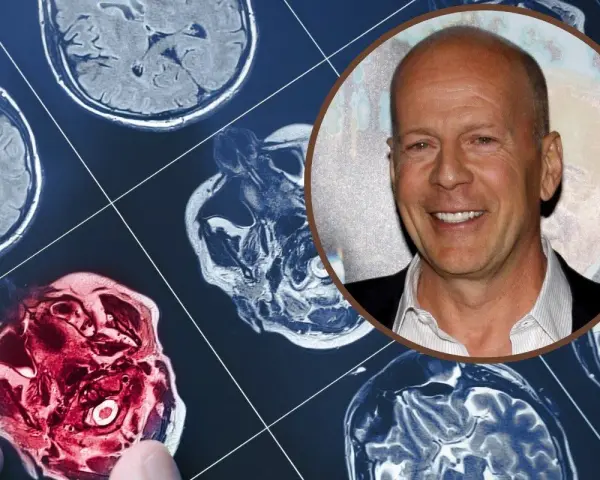 Bruce Willis choroba: obraz rezonansu magnetycznego mózgu obok uśmiechniętej twarzy aktora.