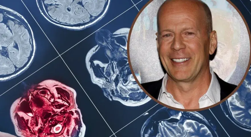 Bruce Willis choroba: obraz rezonansu magnetycznego mózgu obok uśmiechniętej twarzy aktora.